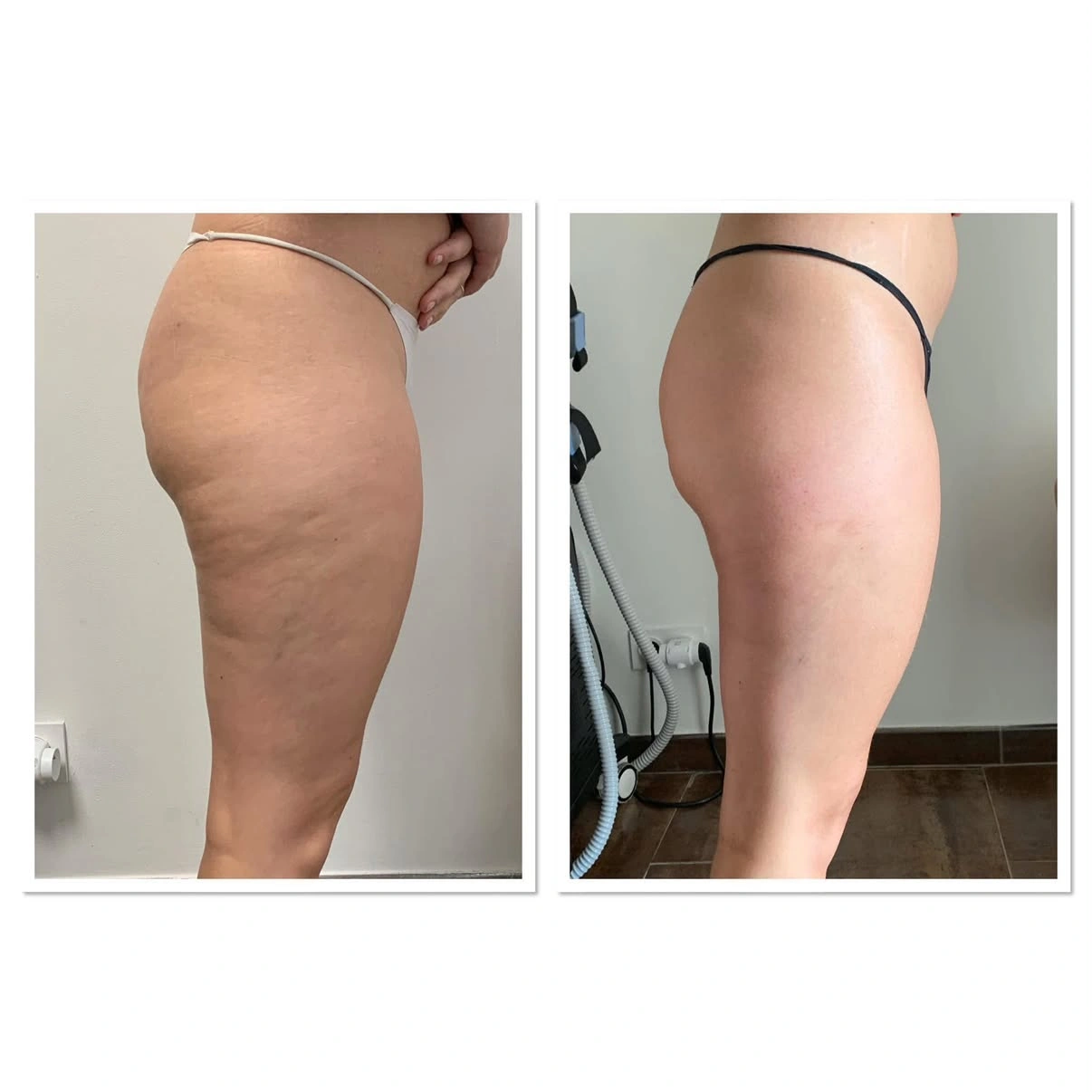 Soin cellulite · présentation avant / après, jambes de profil