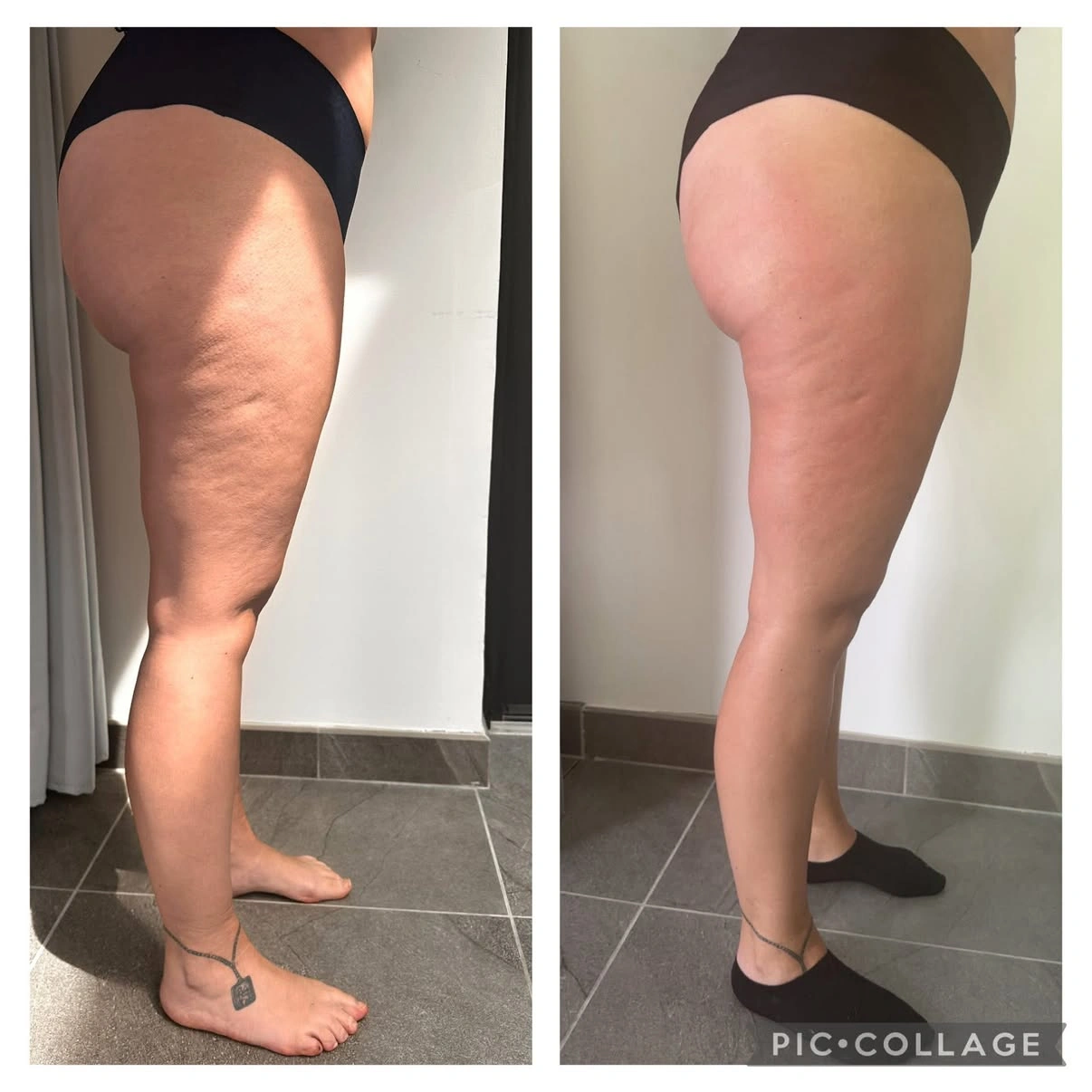 Soin cellulite · présentation avant / après, jambes