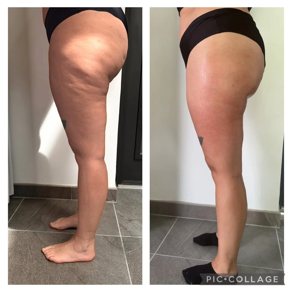 Soin cellulite · présentation avant / après, cuisses de profil
