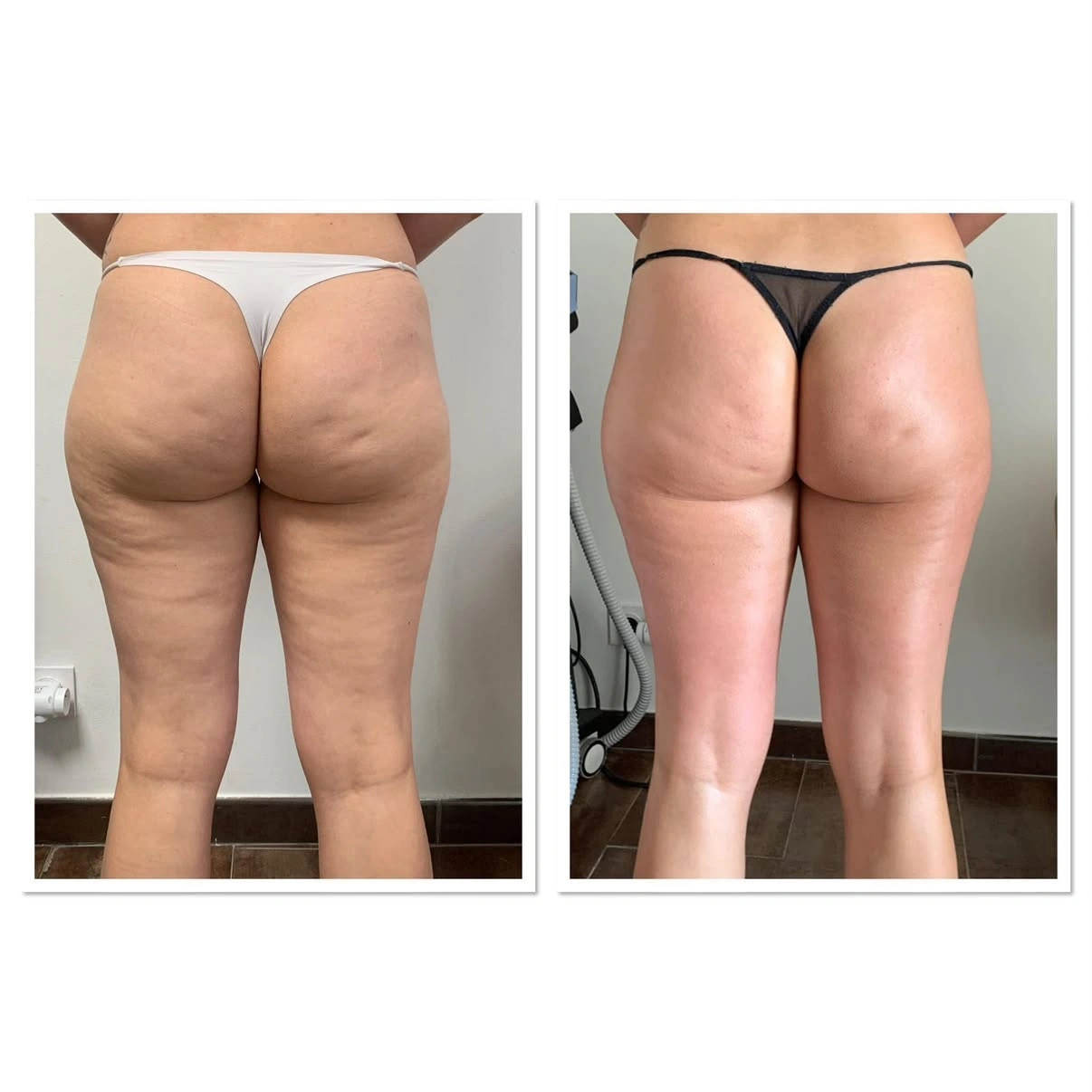 Soin cellulite · présentation avant / après, vue de dos
