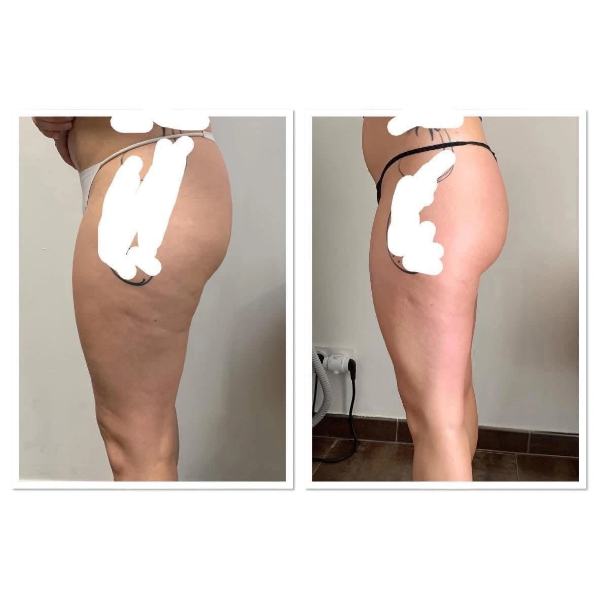 Soin cellulite · présentation avant / après, cuisses de dos