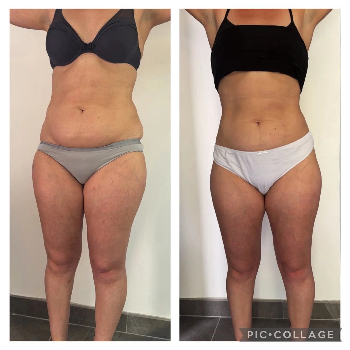 Lipolaser · présentation avant / après, vue de face