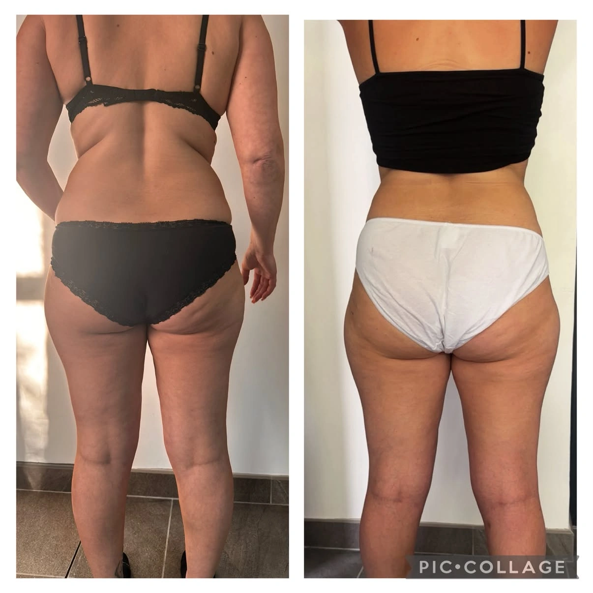 Lipolaser · présentation avant / après, vue de dos