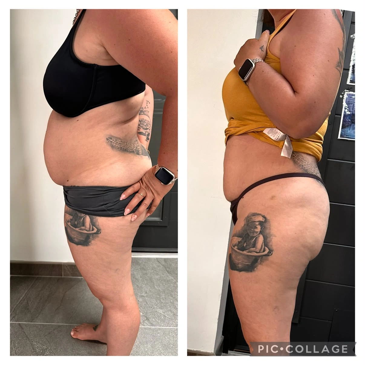 Lipolaser · présentation avant / après, vue de profil