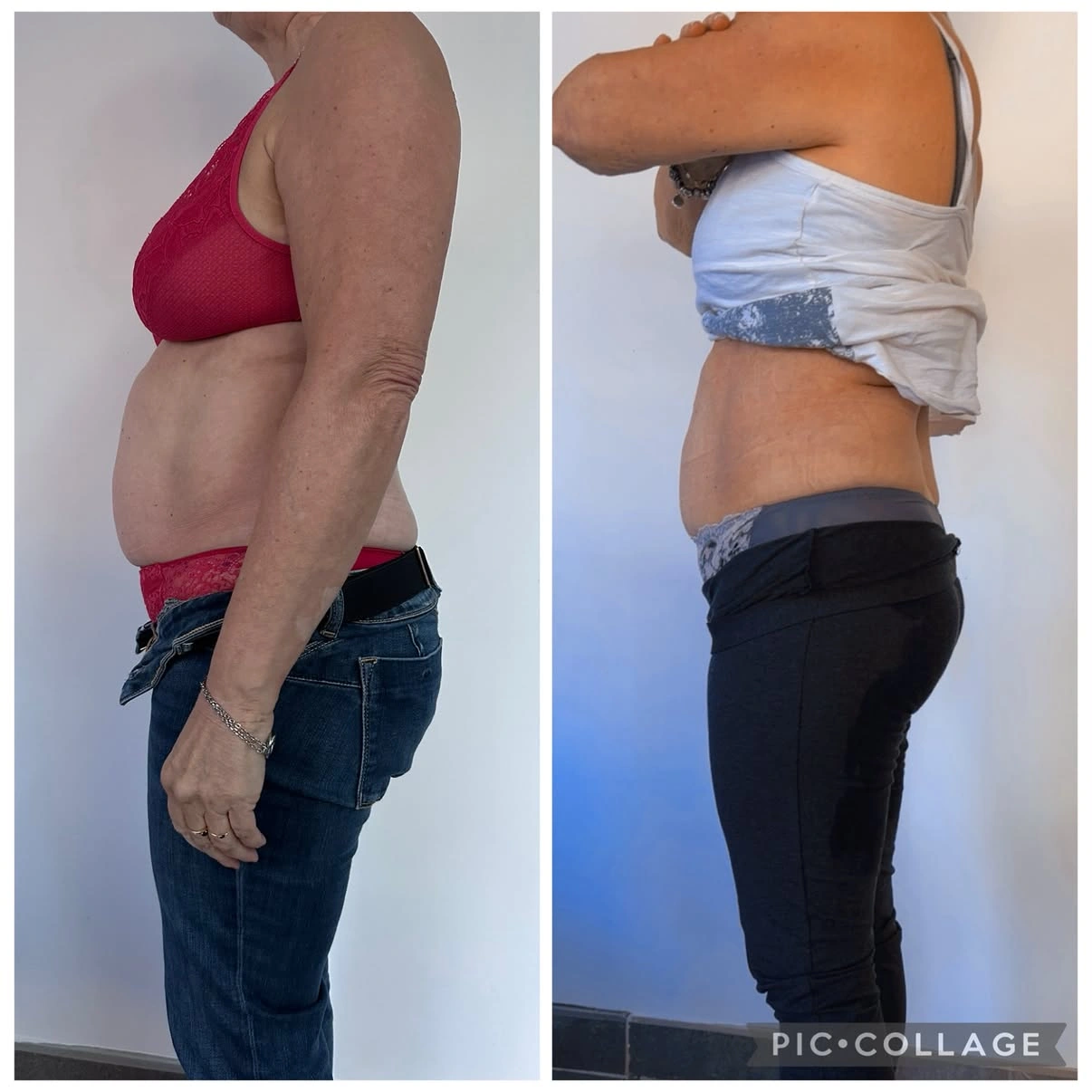 Lipolaser · présentation avant / après, silhouette de profil