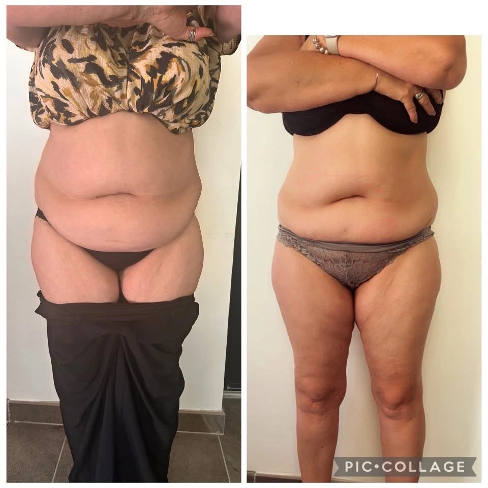 Lipolaser · présentation avant / après, ventre et taille